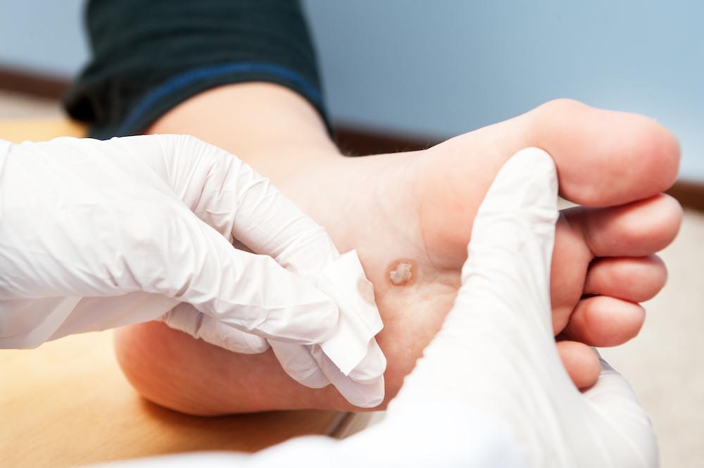 Diabetic Foot Treatment